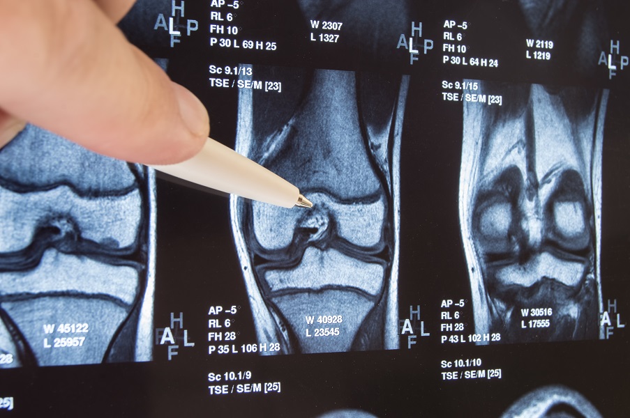 Un nouveau matériau, à base d'acide hyaluronique, fait sa preuve de concept de capacité à régénérer le cartilage endommagé des articulations (Visuel Adobe Stock 171289849).