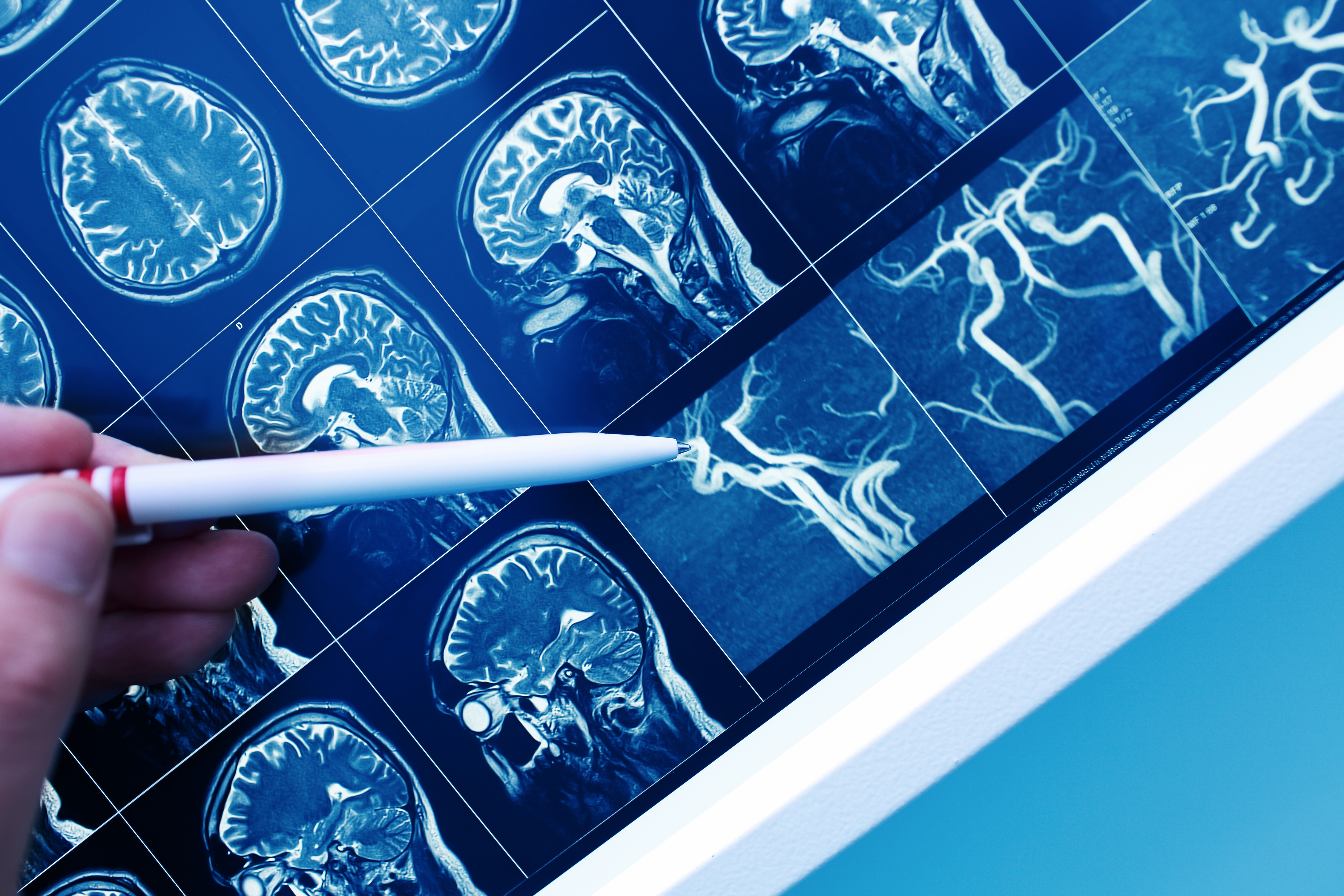 La maladie de Huntington affecte non seulement les cellules nerveuses du cerveau, mais touche également les vaisseaux sanguins microscopiques (Visuel Adobe Stock 209246282)