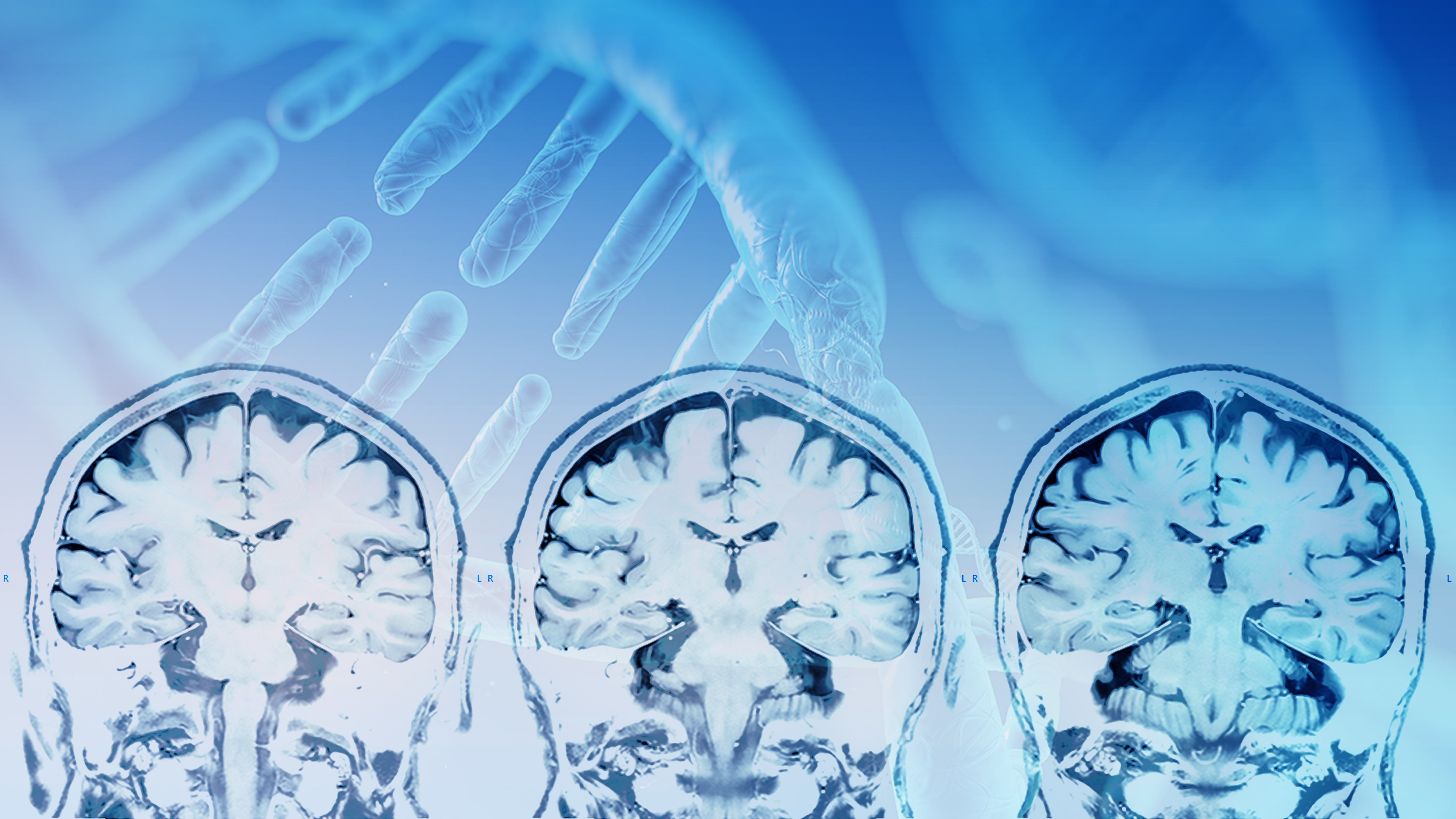 La découverte de ce nouveau gène, RBFOX1, à l’initiative de changements cérébraux précoces, et notamment de la formation de précurseurs amyloïdes et de la dégradation des synapses entre les neurones, pourrait permettre de changer le cours de la maladie (Visuel Adobe Stock 214817004)