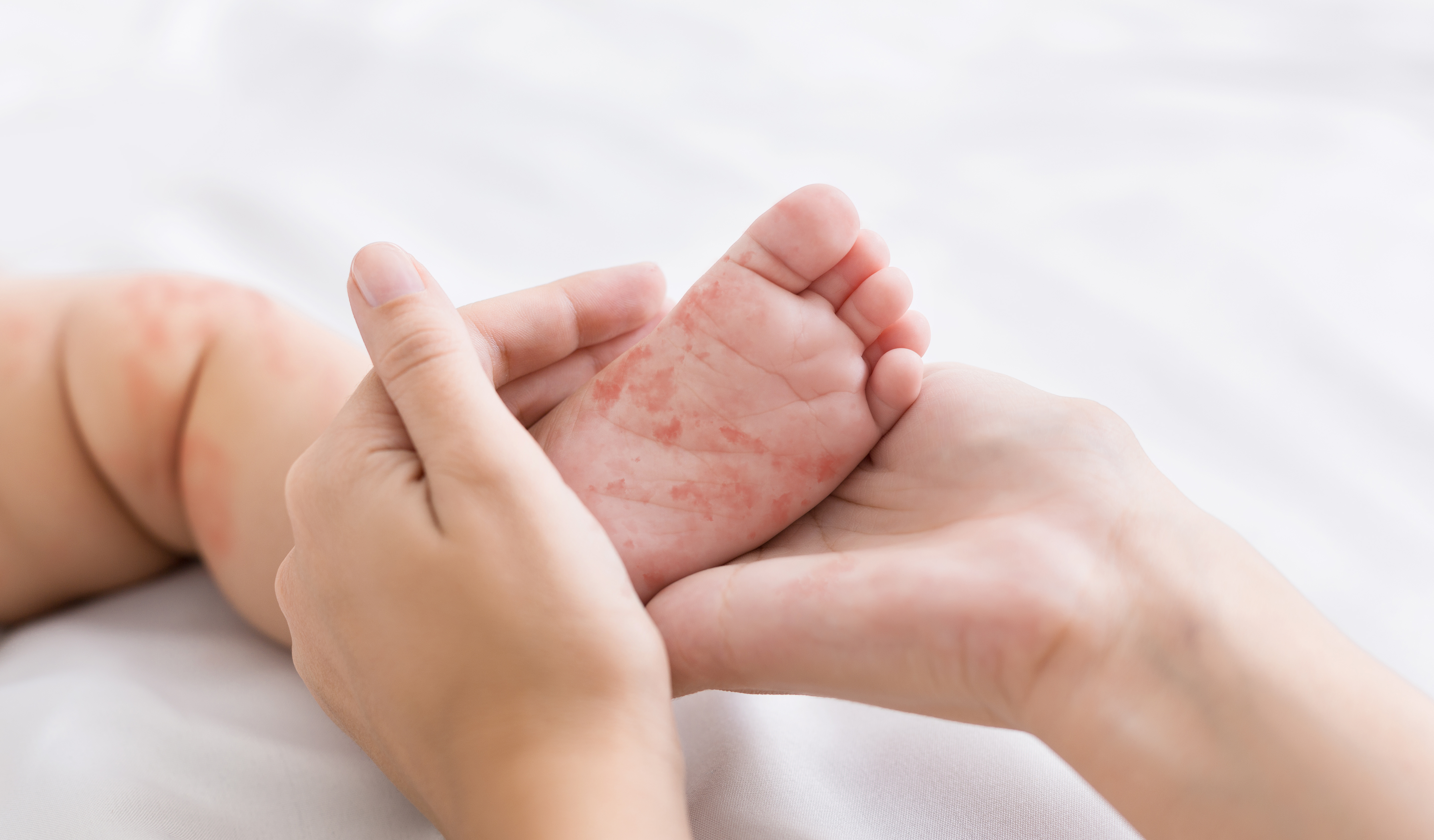 MEASLES: An explanation of its neurological complications