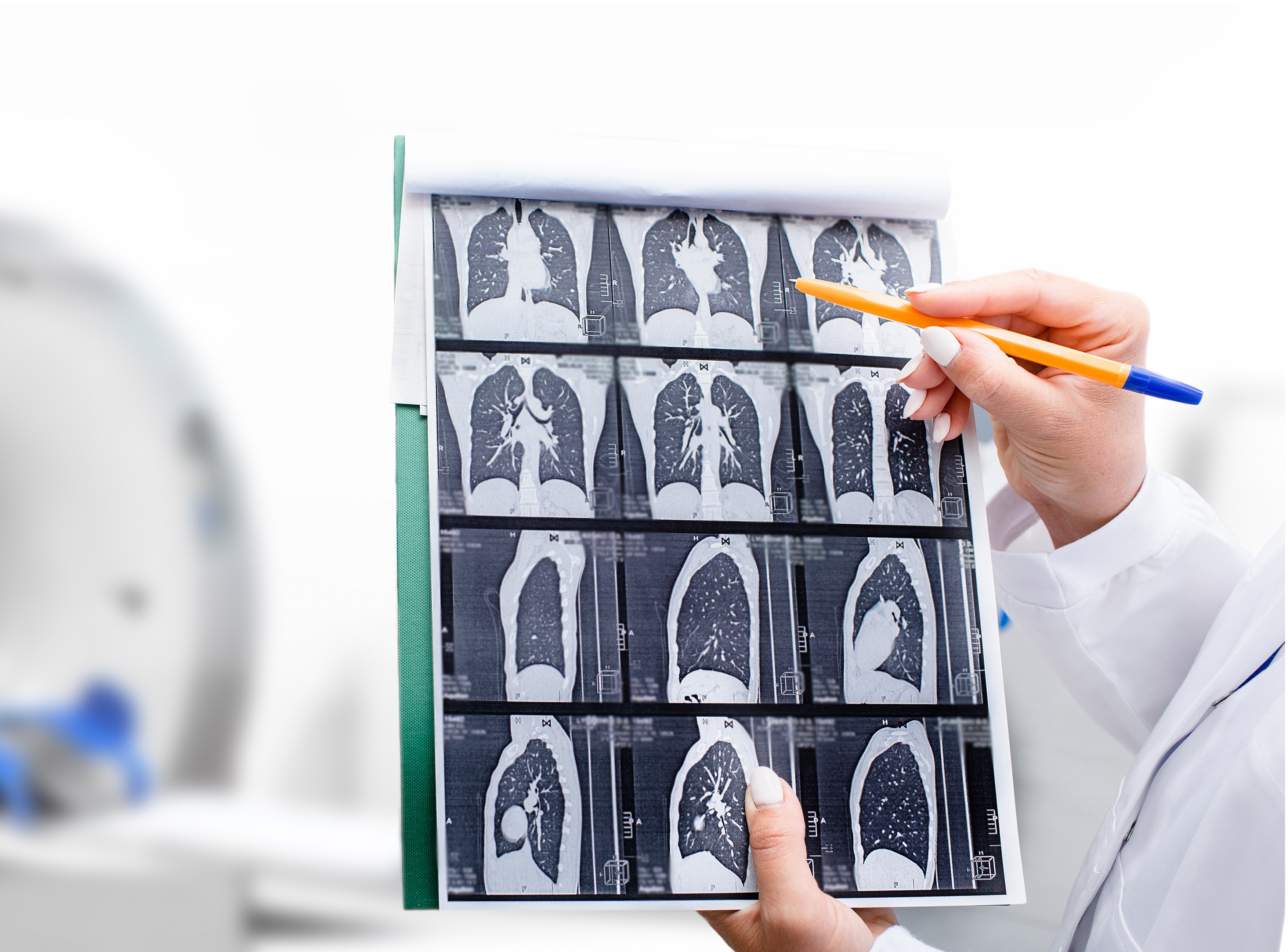 Le dépistage du cancer du poumon prolonge la vie (Visuel Adobe Stock 390810564)