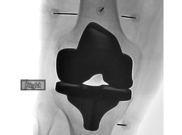 Une technique émergente et peu invasive, l’ablation par radiofréquence et par le froid (crypothérapie) (C-RFA pour cooled radiofrequency ablation) démontre ici son efficacité à soulager la douleur après une arthroplastie du genou (Visuel RSNA et Dr Felix Gonzalez)