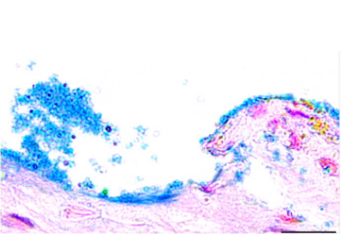 Certaines de ces bactéries deviennent résistantes à de nombreux antibiotiques, en particulier en formant des biofilms (Visuel AlphaMed Press)