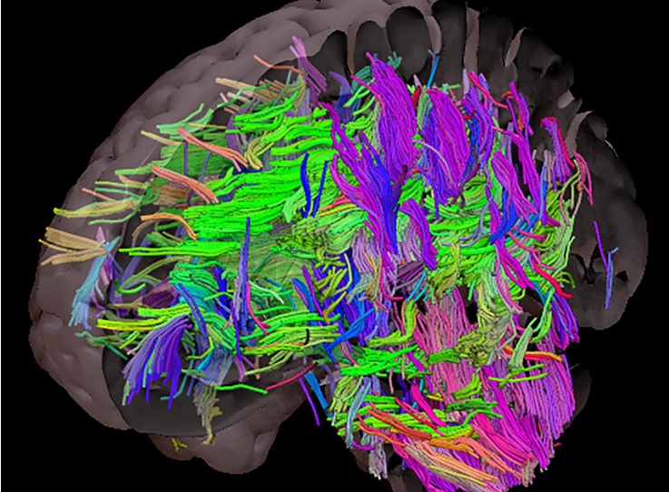 Des tractus de substance blanche sont endommagés chez les personnes présentant des risques cardiovasculaires incontrôlés comme l'obésité (Visuel University of Sheffield) 