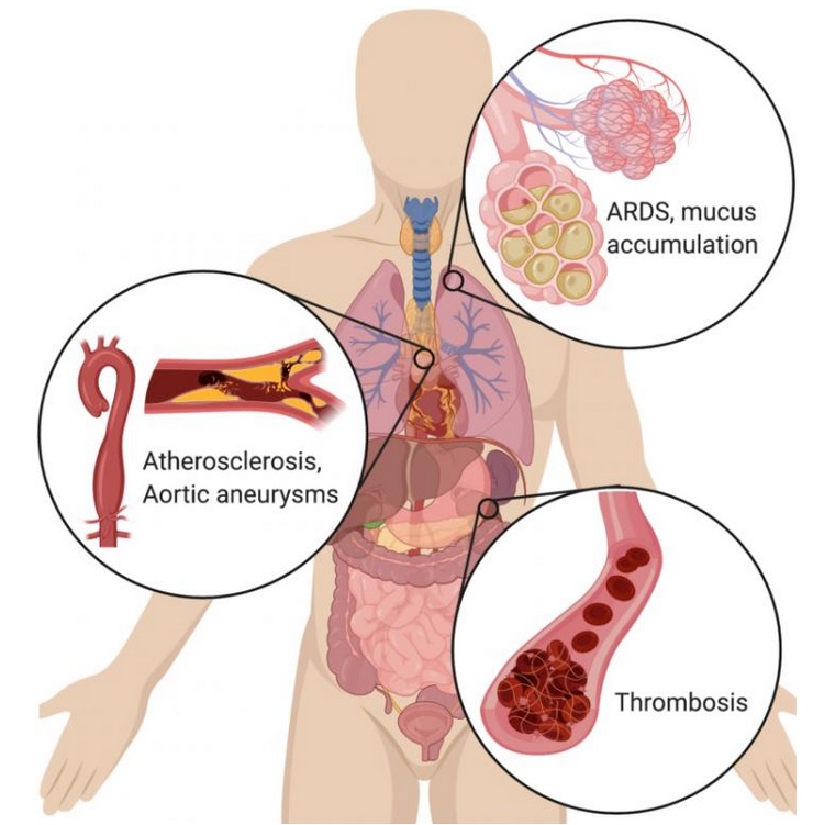 Des cellules immunitaires hyperactives, des neutrophiles, semblent, avec leurs « pièges extracellulaires » causer le décès dans la maladie COVID-19 