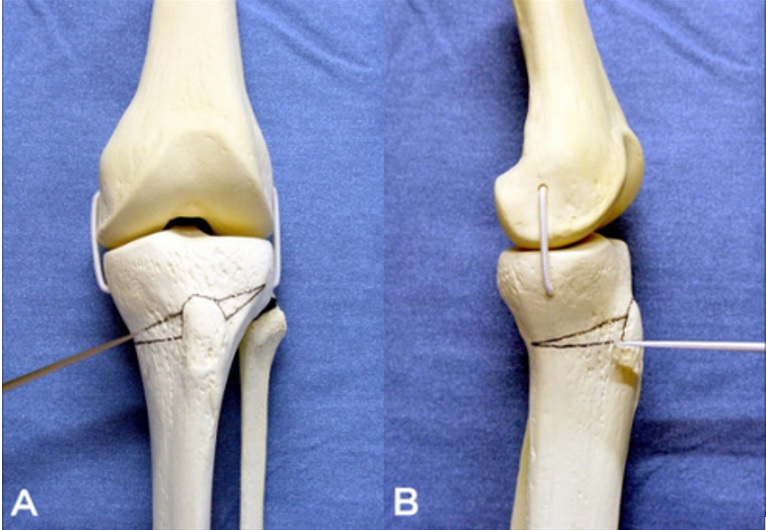 KNEE ARTHROSIS Tibial osteotomy, an alternative to total