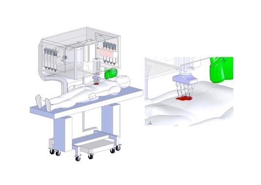 Une bio-imprimante de peau mobile, positionnable « in situ » soit au chevet du patient et qui, à partir de ses propres cellules (autologues) de peau va pouvoir imprimer de la peau, couche par couche, pour initier le processus de cicatrisation