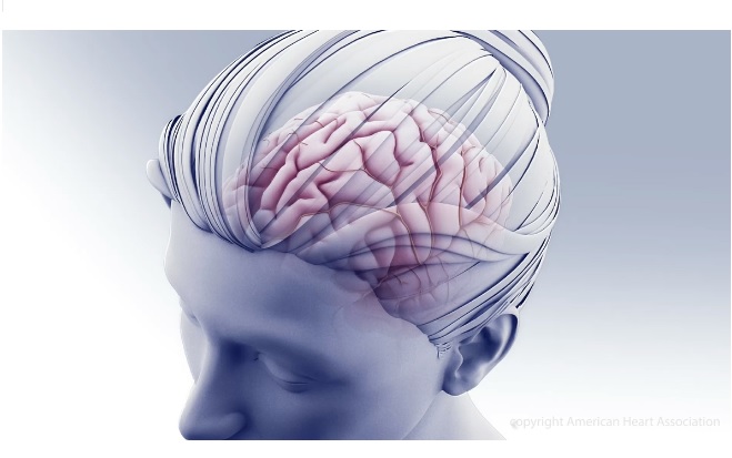 La thrombose des sinus veineux cérébraux (CVST) est caractérisée par la formation de caillots sanguins dans les veines du cerveau (Visuel AHA/ASA)