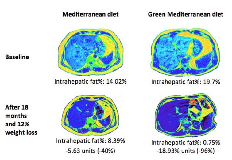 Ces polyphénols, présents dans les noix et le Mankai semblent jouer un rôle majeur dans la réduction de la graisse du foie (Visuel Gut 2021).