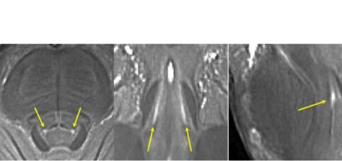 Alors que la plupart des scanners IRM ont tendance à être « 3T » ou moins et ne permettent pas de visualiser avec suffisamment de précision le locus coeruleus, les scanners 7T, qui ont des champs magnétiques ultra-puissants, peuvent fournir une résolution de la taille d'un grain de sable (Visuel Université de Cambridge)