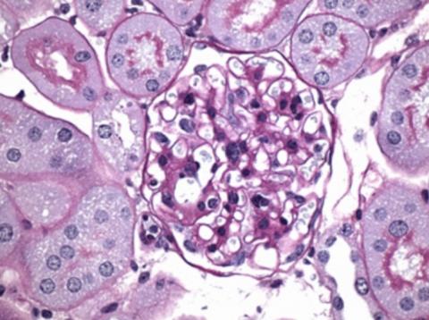 Ce composé, administré à des souris diabétiques a réduit les dommages aux glomérules rénaux (structure plus importante sur visuel ci-dessous) et aux structures environnantes dans le rein, en particulier le tissu cicatriciel (en violet sur visuel)(Visuel A. Schmidt et al., Sci. Trad. Méd. 13, eabf7084 -2021).