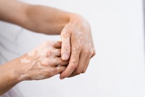 Dans le vitiligo, la suppression d'une enzyme en particulier, pourrait permettre aux mélanocytes de récupérer (Visuel Adobe Stock 512322056)