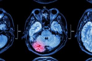 L'intervention consiste à supprimer les nouveaux neurones formés à la suite d'une crise. 