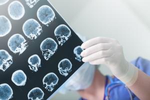  La fréquence des crises et la sévérité de l'épilepsie, ainsi que la réponse du patient à la pharmacothérapie, varient avec la zone du cerveau affectée et d'autres facteurs multiples, complexes, propres à chaque patient