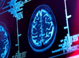 Avec le recours à l’IA, les techniques de stimulation cérébrales pourraient également venir au secours des personnes atteintes de maladies psychiatriques et de lésions cérébrales directes, telles que celles associées aux accidents vasculaires cérébraux (AVC) (Visuel NIH- Abott). 
