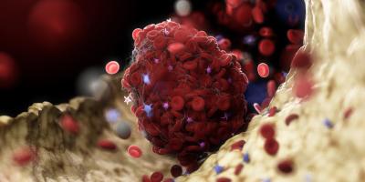 L'interaction des neutrophiles et des plaquettes sanguines mène à un phénomène d’immunothrombose qui précède la détresse pulmonaire (Adobe Stock 315109779)