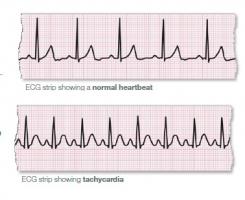 La fibrillation auriculaire (FA) est une affection cardiaque qui provoque un rythme cardiaque irrégulier et souvent anormalement rapide. 