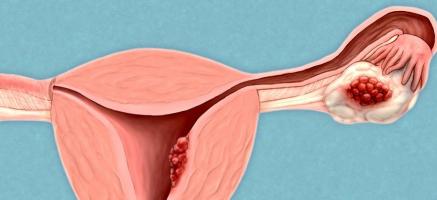 Le cancer de l'ovaire reste l'un des cancers les plus meurtriers car il n'existe aujourd’hui aucune méthode de dépistage et qu'il est souvent diagnostiqué (trop) tardivement.